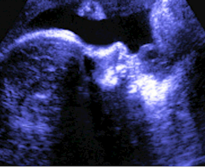 Elastography shows women with COVID history have stiffer placentas